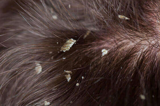 Oily & Dandruff